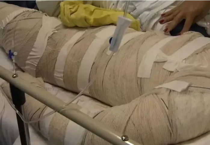 Criança morre após explosão enquanto tia queimava carrapatos de cachorro em MS